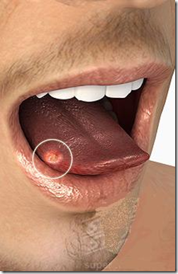 úlcera en lengua causada por mordedura a repetición