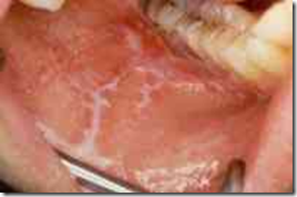 Zona de Leucoplasia y eritroplasia que amerita biopsia, parte interna de la mejilla.